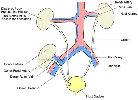 Carriage House Plans: Kidney Transplant Procedure