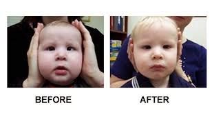 Medical Treatment Pictures-for Better Understanding: Strabismus Surgery ...