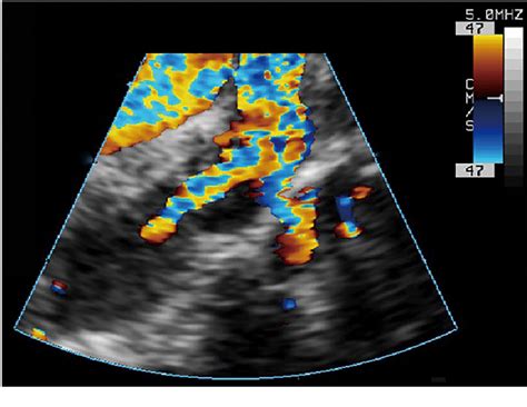 figure   transventricular valvotomy  pulmonary atresia