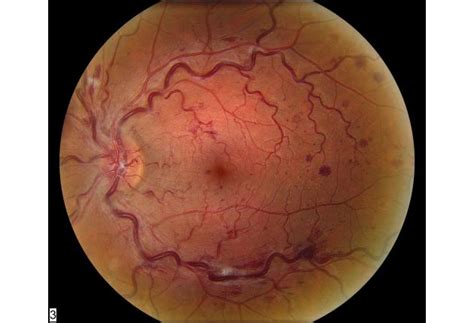 Retinal Artery Occlusion Symptoms