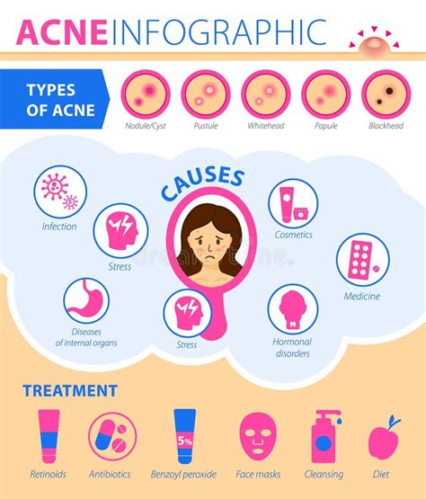 Tipos De Acne Causadoras Do Tratamento Da Doença Infográficos De Acne