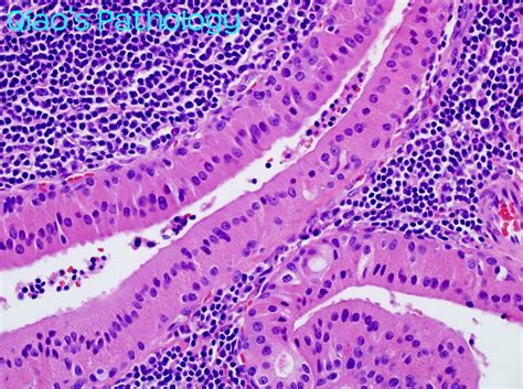 Tumor Warthin Tumor