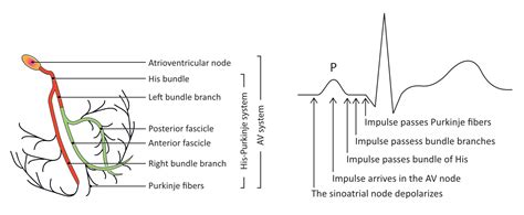 Pacemaker Icd Crt Ecg The Cardiovascular