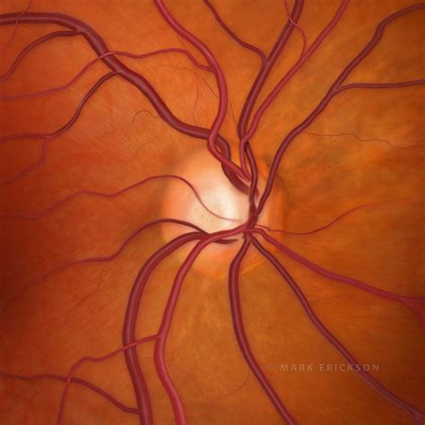 Optic nerve cupping in glaucoma, 0.6 c/d ratio, glaucoma illustration