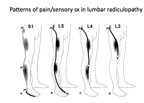 16. RADICULOPATHY SYMPTOMS Flashcards | Quizlet