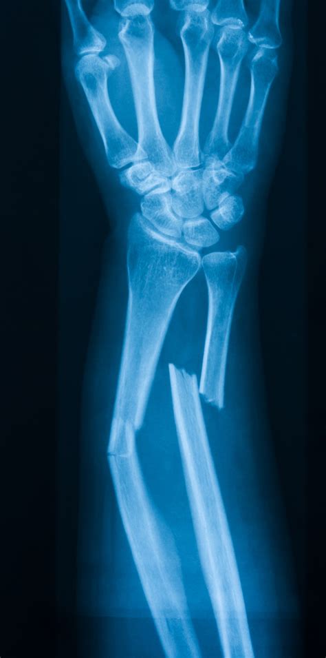 Types Of Hip Fractures Fracture Treatment