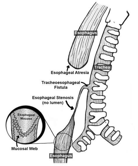 Illustration Of The Anatomy Of Esophageal Atresia With Distal