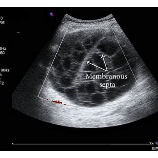 Abdominal Ultrasonography Us Showing A Well Defined Large Cystic Mass