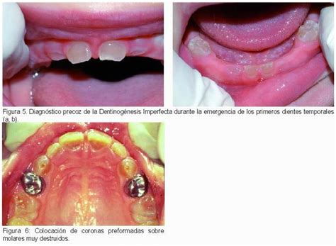 La Dentinog Nesis Imperfecta Como Alerta De Osteog Nesis Imperfecta