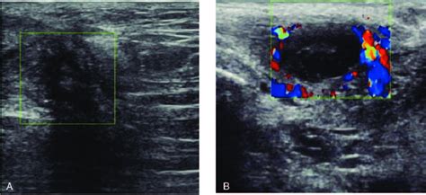 The Typical Ultrasonographic Images Of Perineal Endometriosis Patients