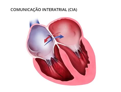 Comunicação Inter Atrial - Modelo De Coracao Septo Interatrial Comunicação Interatrial (CIA):