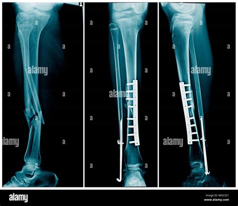 Fracture Of Tibia And Fibula High Resolution Stock Photography And