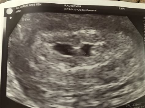 Early Molar Pregnancy Ultrasound