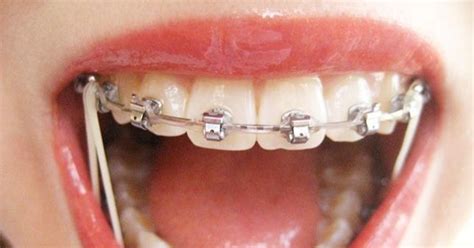 Зачем нужны резинки на брекетах — Underson Clinic