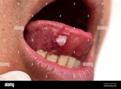 Tongue Cancer Symptoms