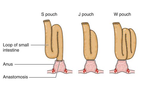 Restorative Proctocolectomy With Ileo Anal Pouch