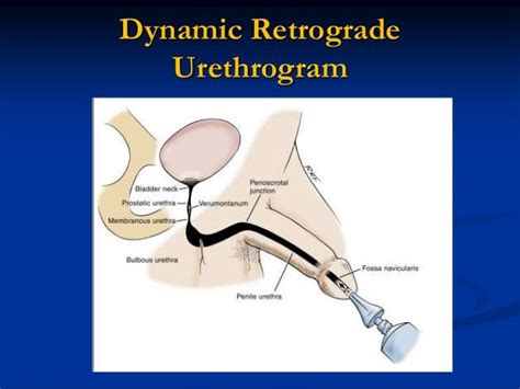 Diagosis Of Urethral Stricture