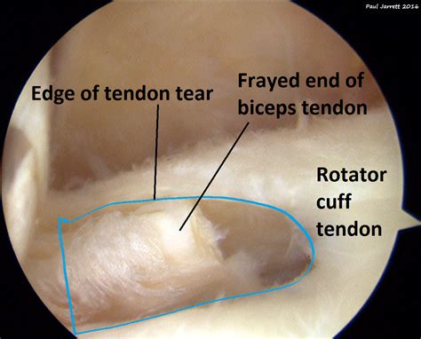 Grade 2 Rotator Cuff Tear