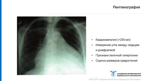 Перикардит