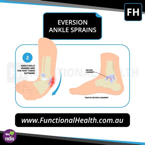 Eversion Ankle Sprain Functional Health Physio Physiotherapy Gold