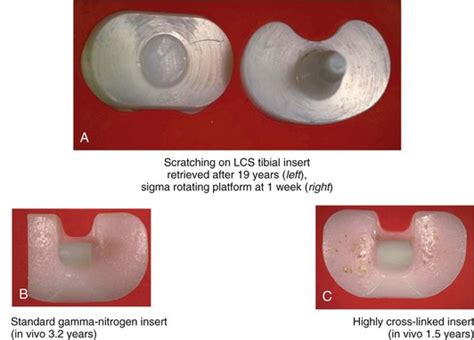 Knee Wear Musculoskeletal Key