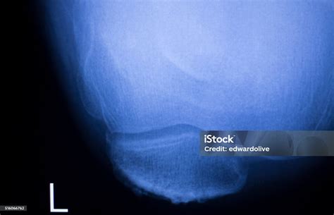 Lutut Dan Meniskus Cedera Xray Scan Foto Stok Unduh Gambar Sekarang