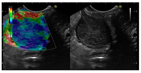 endoscopic ultrasound advanced techniques  diagnosis