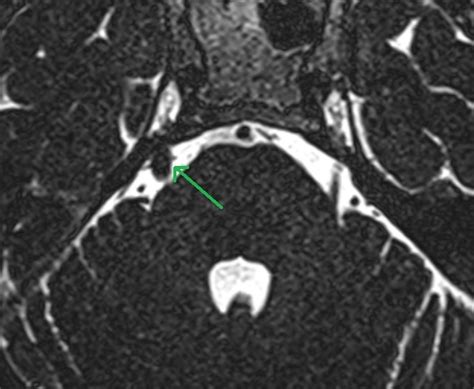 Trigeminal Nerve Mri Protocol