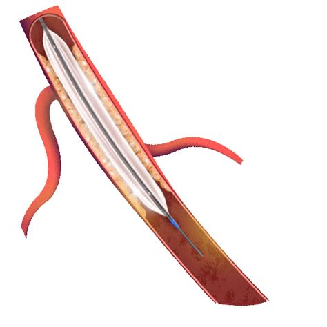 Pta Balloon Catheter A Breakthrough Device For Precision Pta Procedures