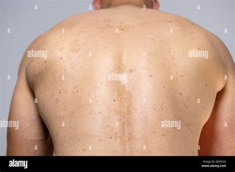 Tinea Versicolor On The Back Pityriasis Versicolor Problem With Skin