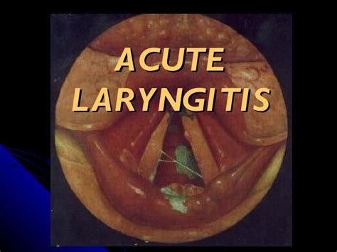 49 best images about Laryngitis on Pinterest | Mouths, Medicine and ...