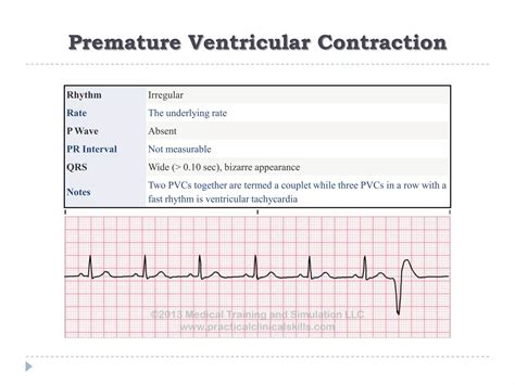 Ecg Or Ekg Sample Strips Ms Cardiovascular Ppt