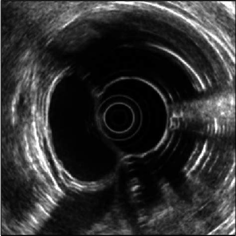 Endoscopic Ultrasound Finding Hypoechoic Uniloculated Cyst With