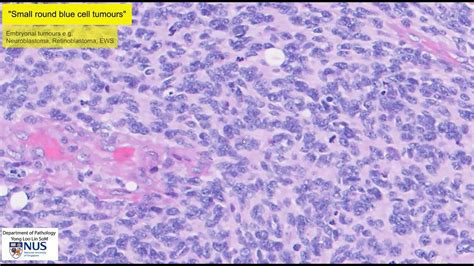 Medulloblastoma Histology