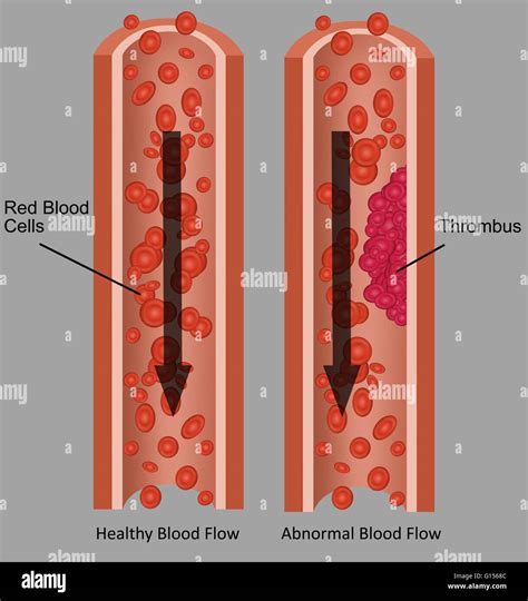 Ilustraciones Que Muestran El Flujo Sangu Neo Y El Flujo Anormal De