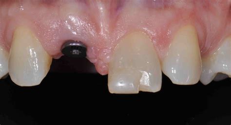 Anterior Implant Abutment Design Lee Ann Brady Dmds Dental Blog