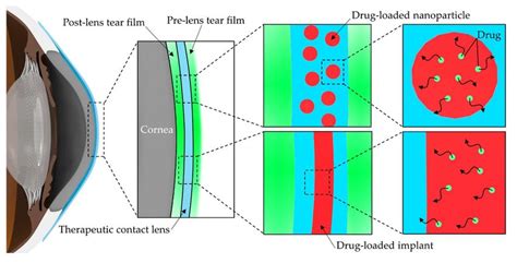 Therapeutic Contact Lenses With Polymeric Vehicles For Ocular Drug