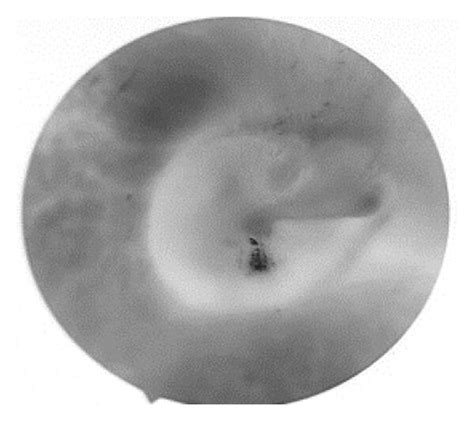 A Normal Right Eardrum A White Image B Red Image C Green