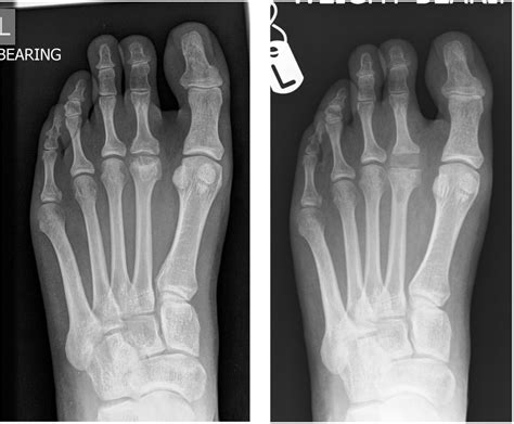 Bofas Hyperbook Forefoot Disorders Freibergs Disease