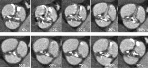 Multidetector Computed Tomography Evaluation Of Candidates For