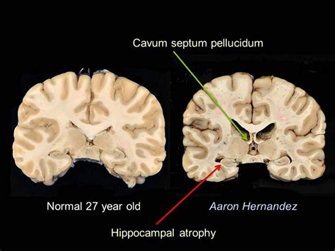 Report Photos Reveal Aaron Hernandez Had Worst Cte Of Anyone His Age
