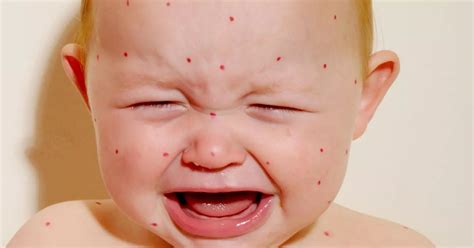Ibuprofen warning for parents dealing with chickenpox - Surrey Live