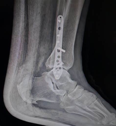 TRUE LOCK Distal Fibula Plate | TRUEMED Medikal