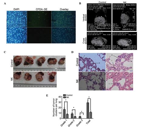 Natural Killer Cells Inhibit Pulmonary Metastasis Of Hepatocellular Carcinoma In Nude Mice