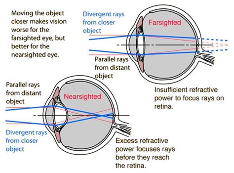 Hyperopia Ray Diagram