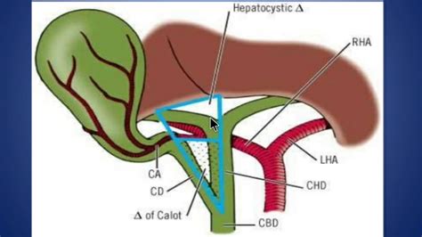 Calots Trianglehepatobiliary Triangle And Hepatocystic Triangle