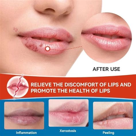 Крем против герпеса и трещин на губах Sumifun, 20 гр. Косметика оптом ...