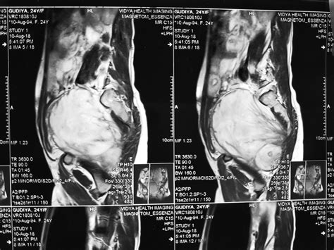 Sagittal Section Of T2 Weighted Mri Pelvis Showing A Large Soft Tissue Download Scientific