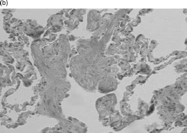 Representative in vitro proliferative responses to donor-derived ...