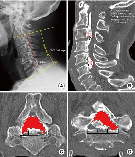 Figure 1 From Assessment Of Cervical Myelopathy Risk In Ossification Of